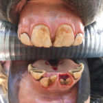 This three-year-old filly has two upper permanent central incisors and has just recently lost the ‘caps’ of her lower central incisors revealing the erupting adult teeth. Within the next few months her four central incisors will be in full wear against one another.