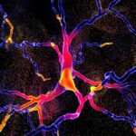 Illustration of the degeneration of dopaminergic neurons, a key stage of development of Parkinson’s disease. (Dr_Microbe/iStock/Getty Images)