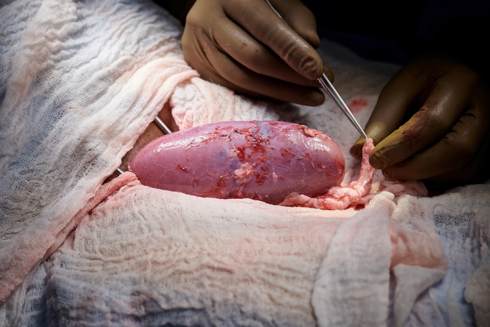 A genetically engineered pig kidney appears healthy during a transplant operation at NYU Langone in New York. (Photo: Joe Carrotta/NYU Langone Health/Handout via Reuters)
